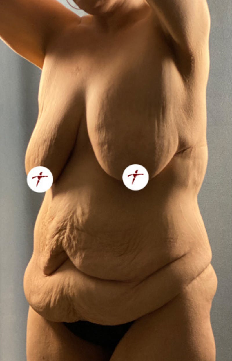 Selfie Gallery Before & After Gallery - Patient 324510 - Image 1