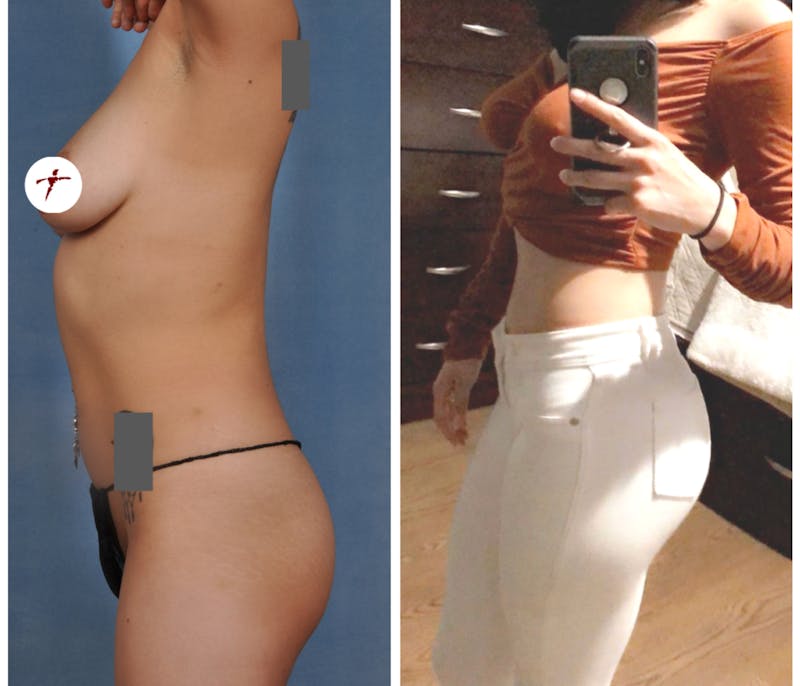 Selfie Gallery Before & After Gallery - Patient 872476 - Image 1