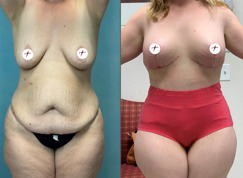 Selfie Gallery Before & After Gallery - Patient 112316 - Image 1