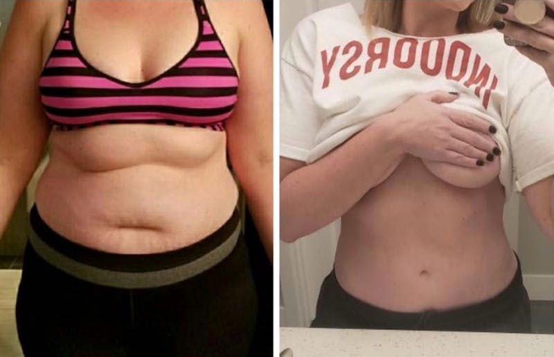 Selfie Gallery Before & After Gallery - Patient 301210 - Image 1