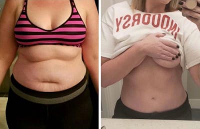 Selfie Gallery Before & After Gallery - Patient 301210 - Image 1