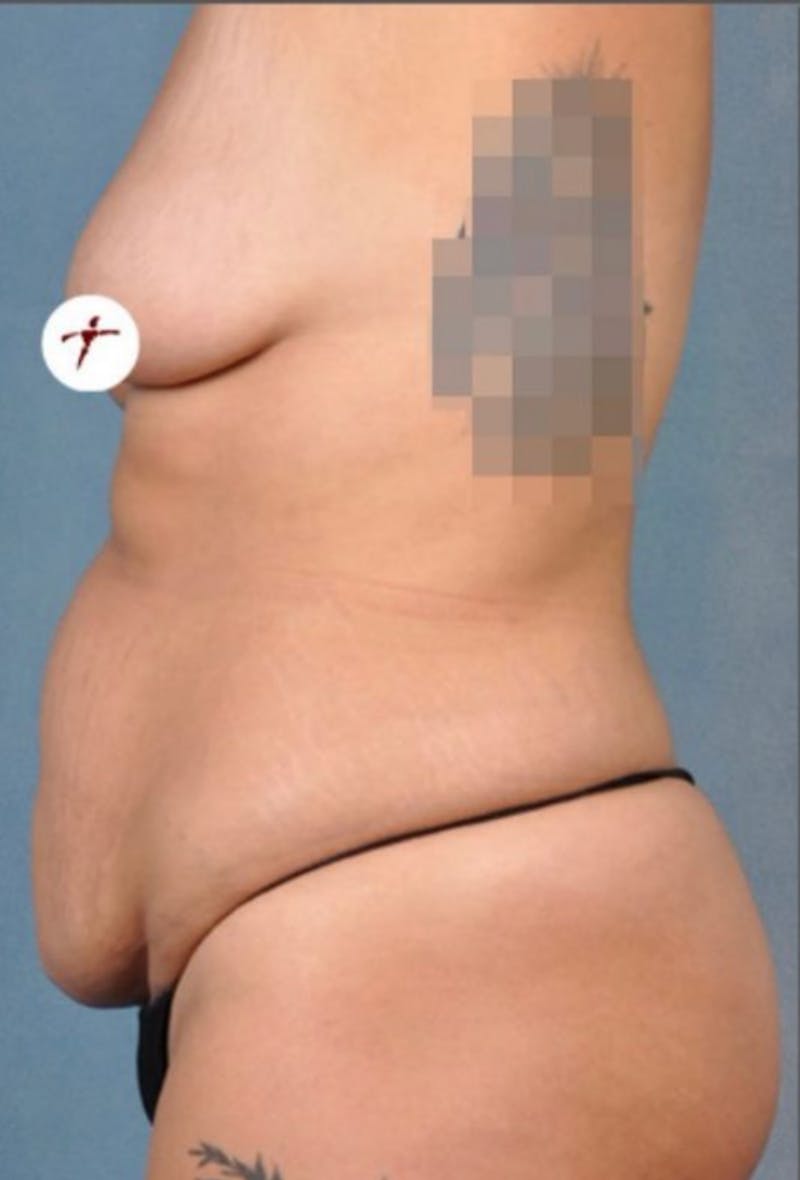 Selfie Gallery Before & After Gallery - Patient 158628 - Image 1