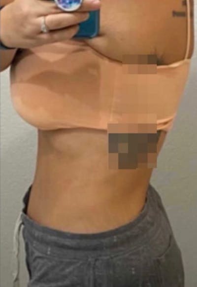 Selfie Gallery Before & After Gallery - Patient 158628 - Image 2