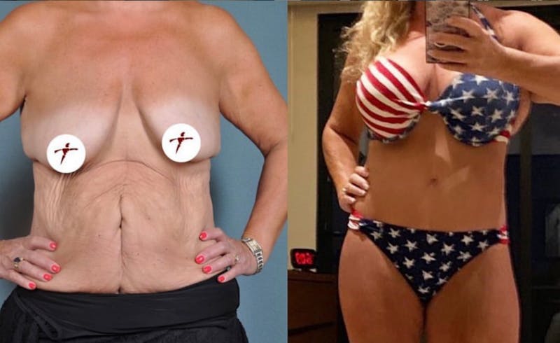Selfie Gallery Before & After Gallery - Patient 222072 - Image 1