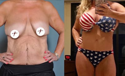 Selfie Gallery Before & After Gallery - Patient 222072 - Image 1