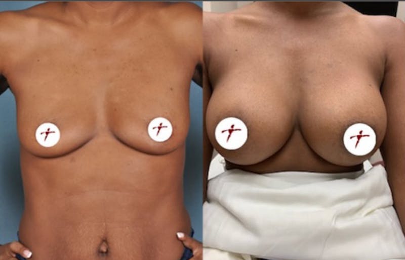 Selfie Gallery Before & After Gallery - Patient 109204 - Image 1