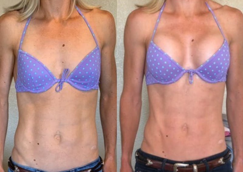 Selfie Gallery Before & After Gallery - Patient 311077 - Image 1