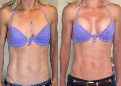 Selfie Gallery Before & After Gallery - Patient 311077 - Image 1