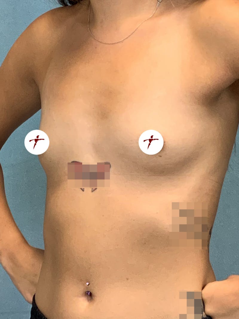 Selfie Gallery Before & After Gallery - Patient 427970 - Image 1