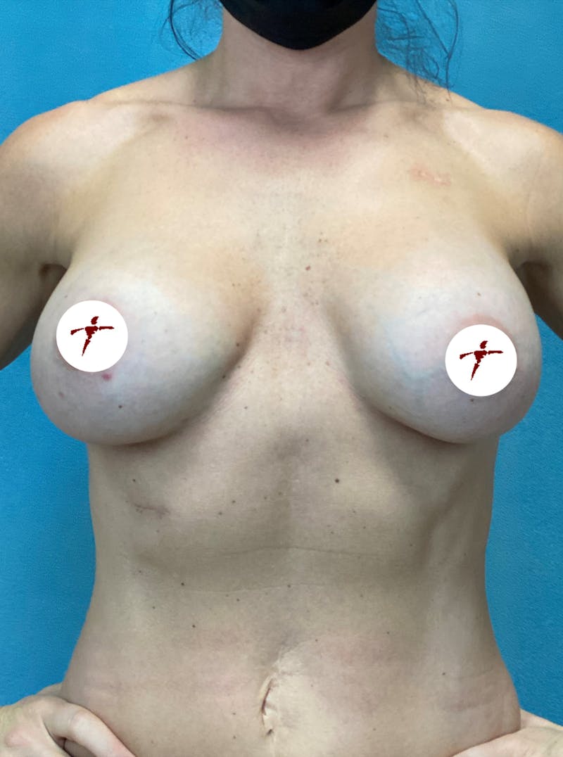 Selfie Gallery Before & After Gallery - Patient 262326 - Image 1