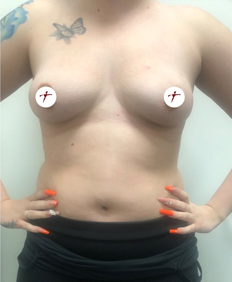 Selfie Gallery Before & After Gallery - Patient 111433 - Image 1