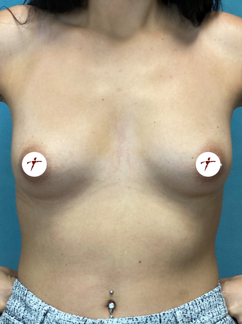 Selfie Gallery Before & After Gallery - Patient 212235 - Image 1