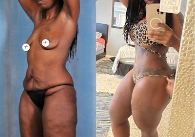 Selfie Gallery Before & After Gallery - Patient 341633 - Image 1
