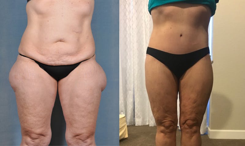 Selfie Gallery Before & After Gallery - Patient 122441 - Image 1