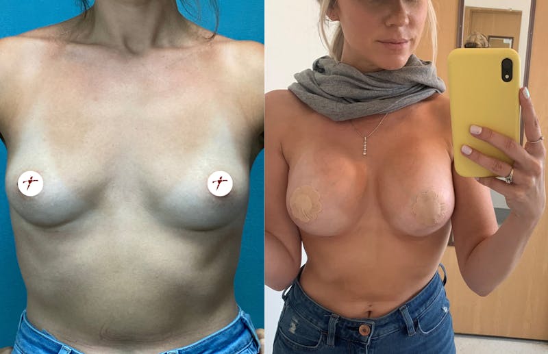 Selfie Gallery Before & After Gallery - Patient 124554 - Image 1