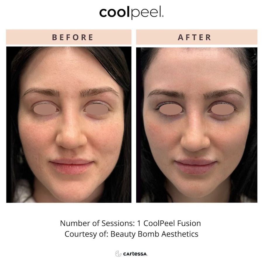 coolpeel results