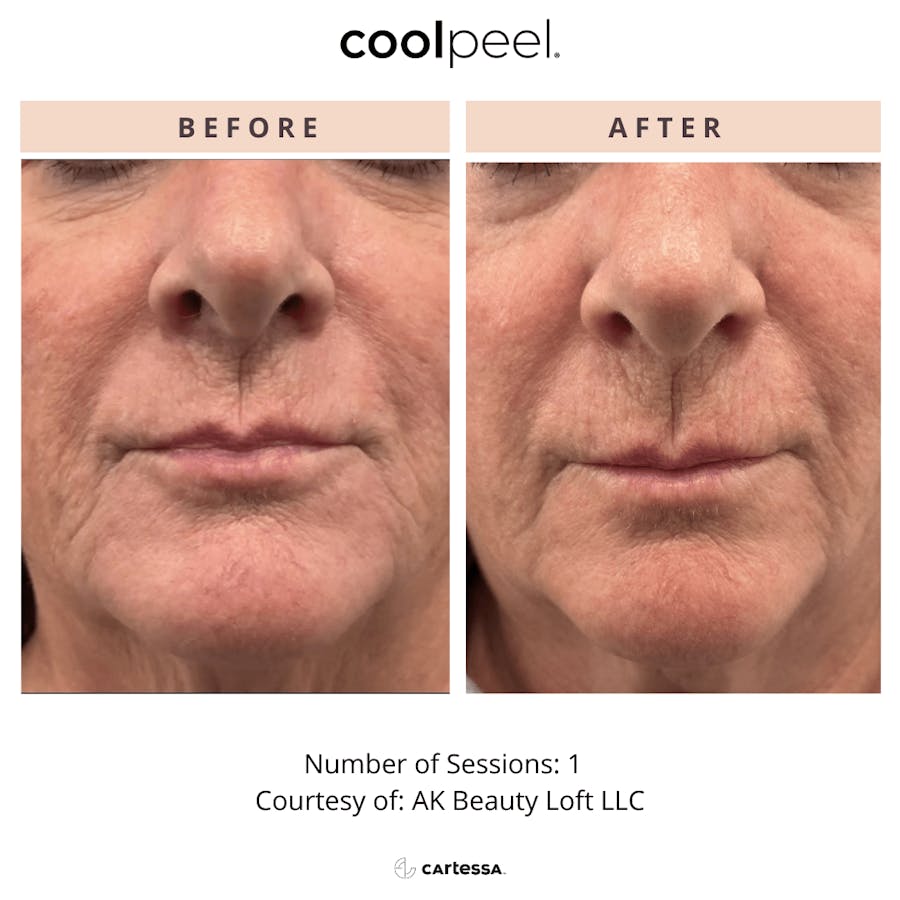 coolpeel results