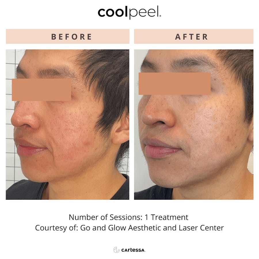 coolpeel results