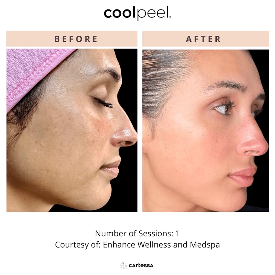 coolpeel results