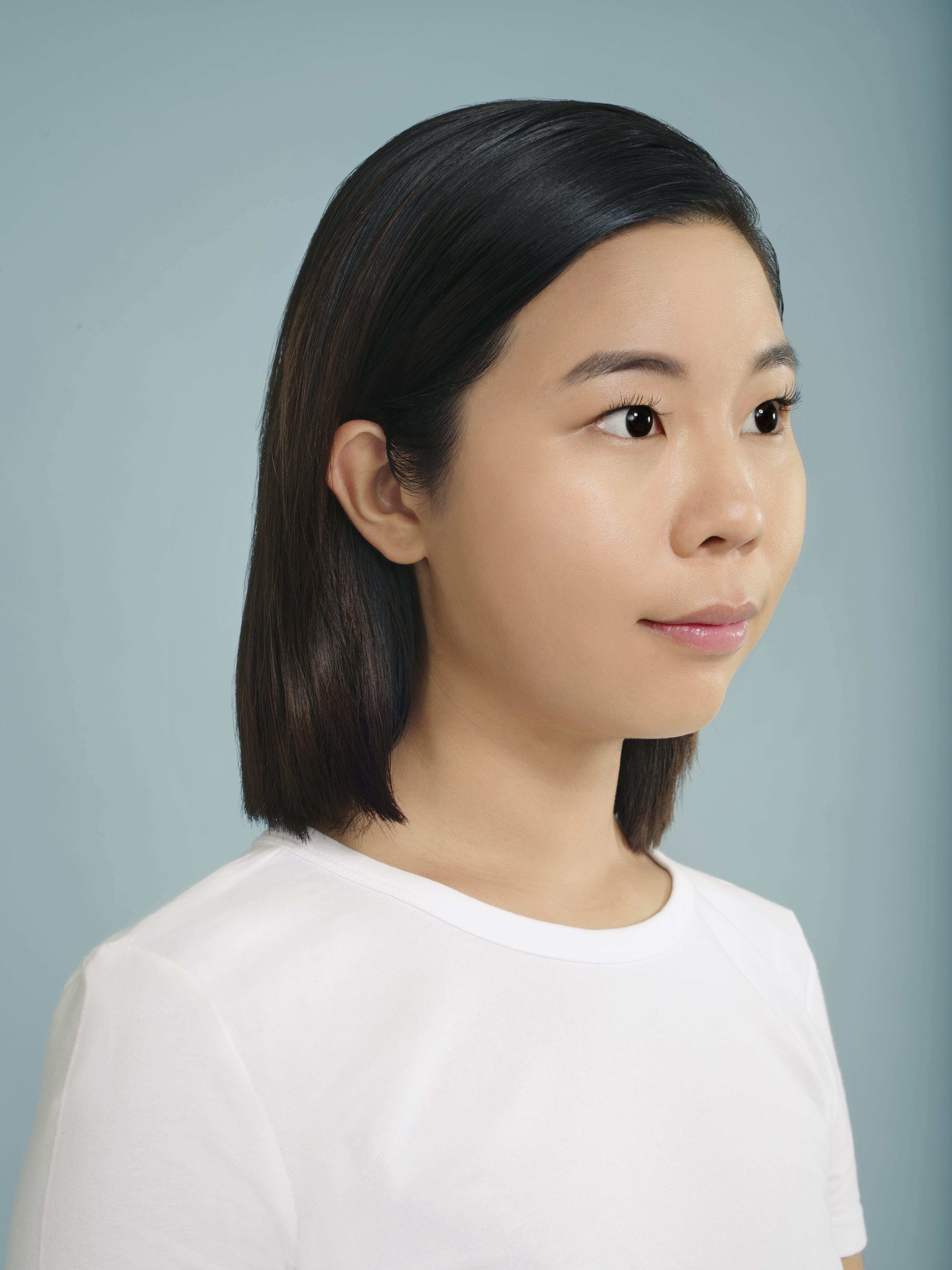 restylane patient