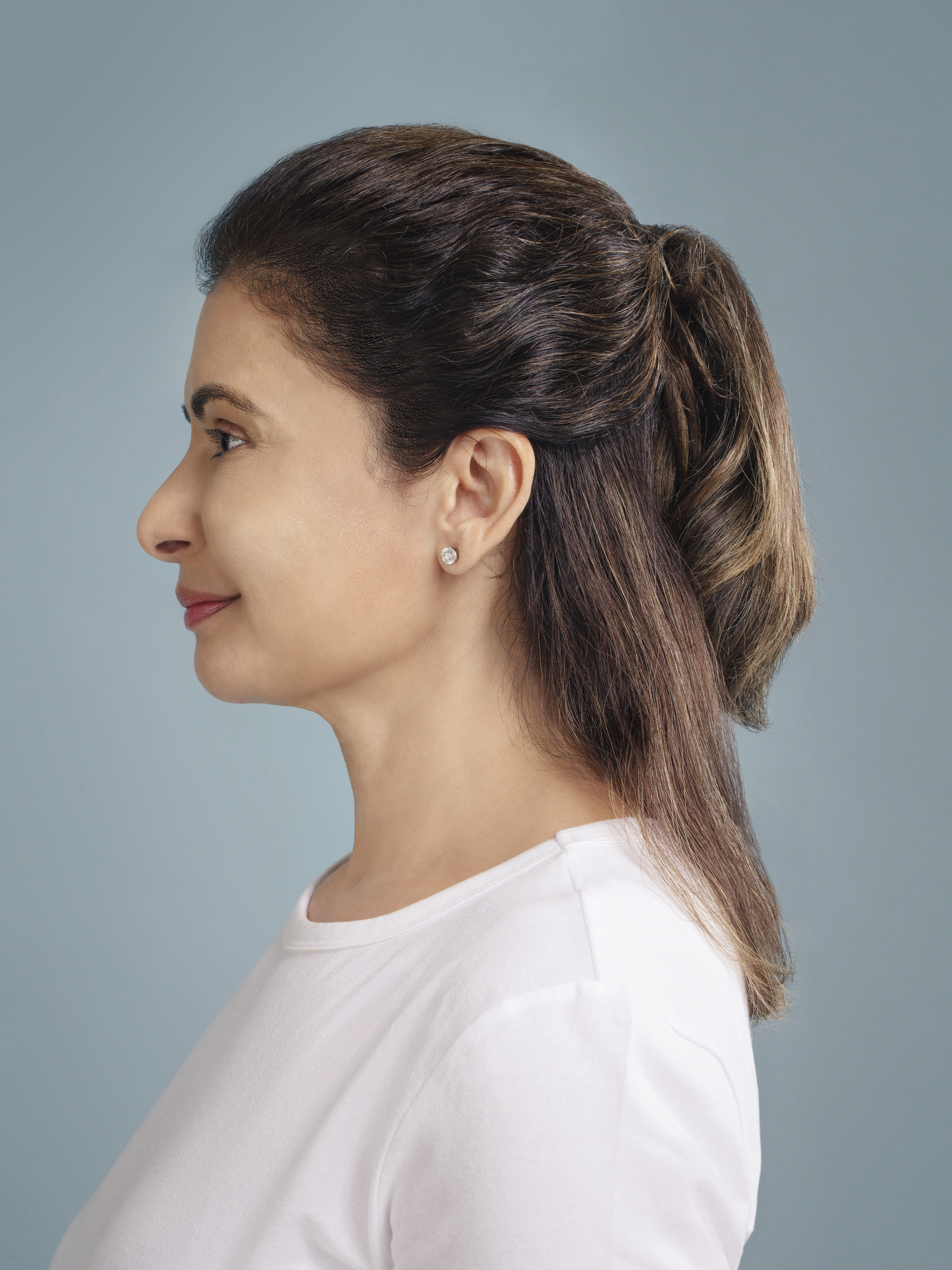 restylane patient