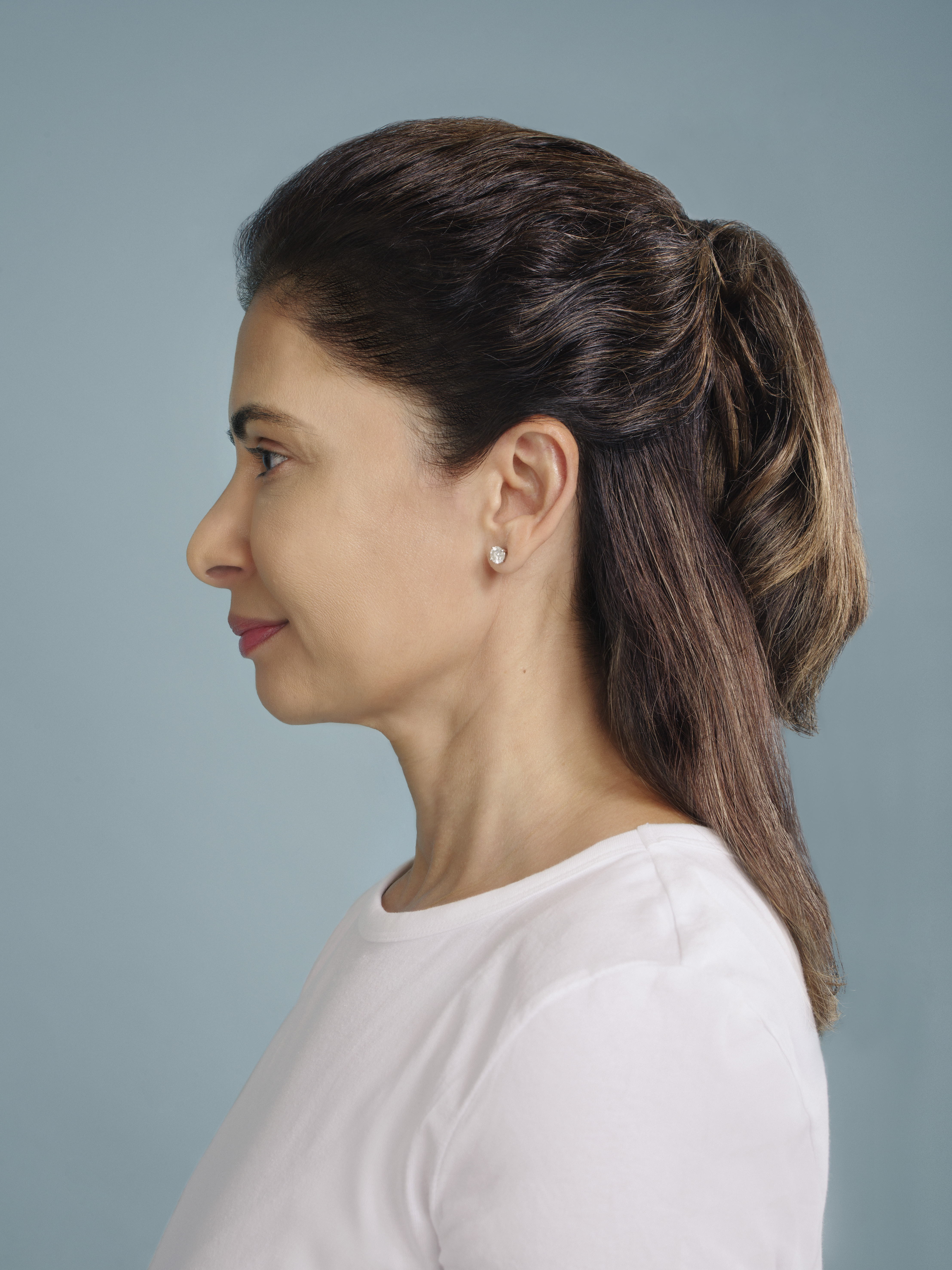 restylane patient