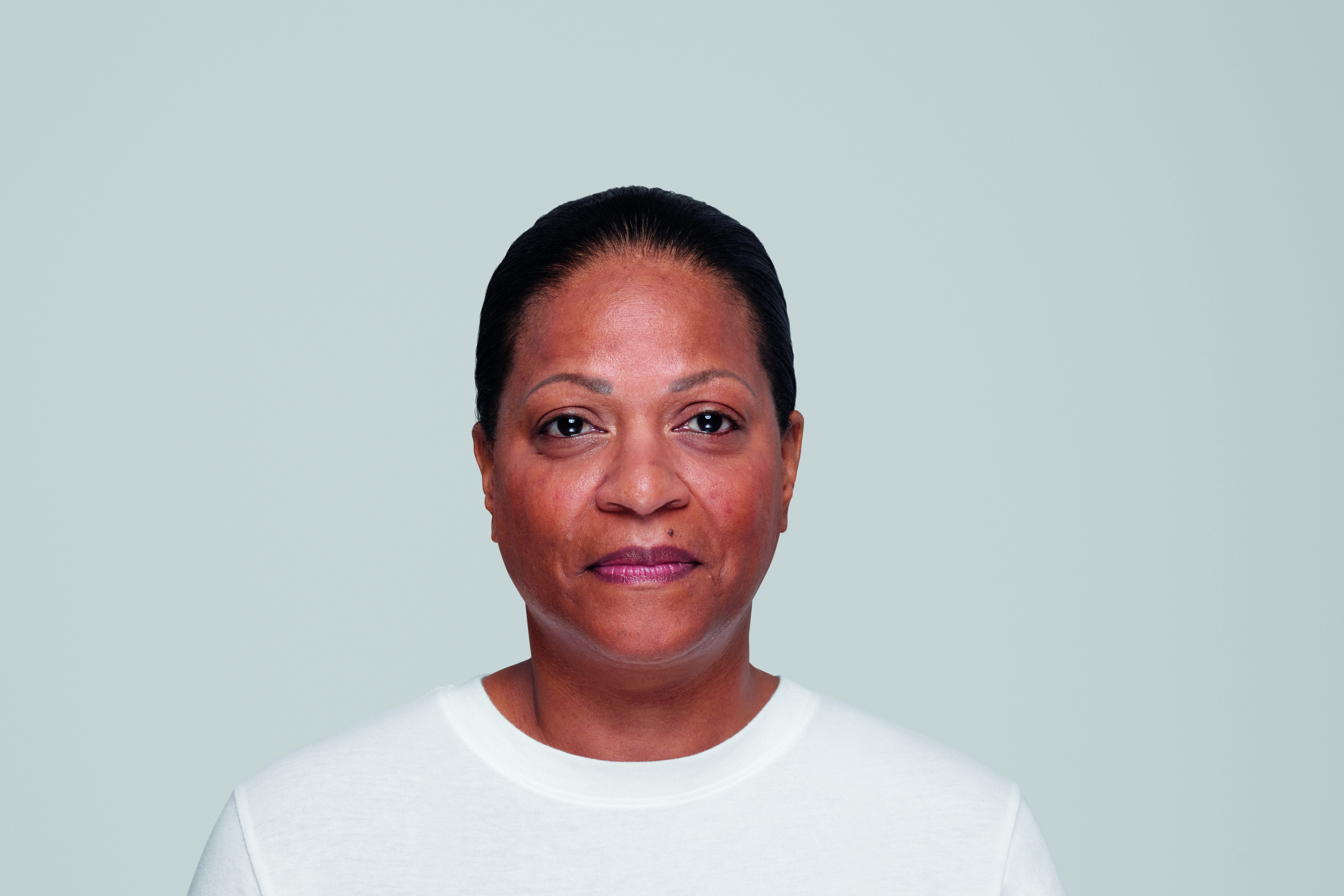 restylane patient