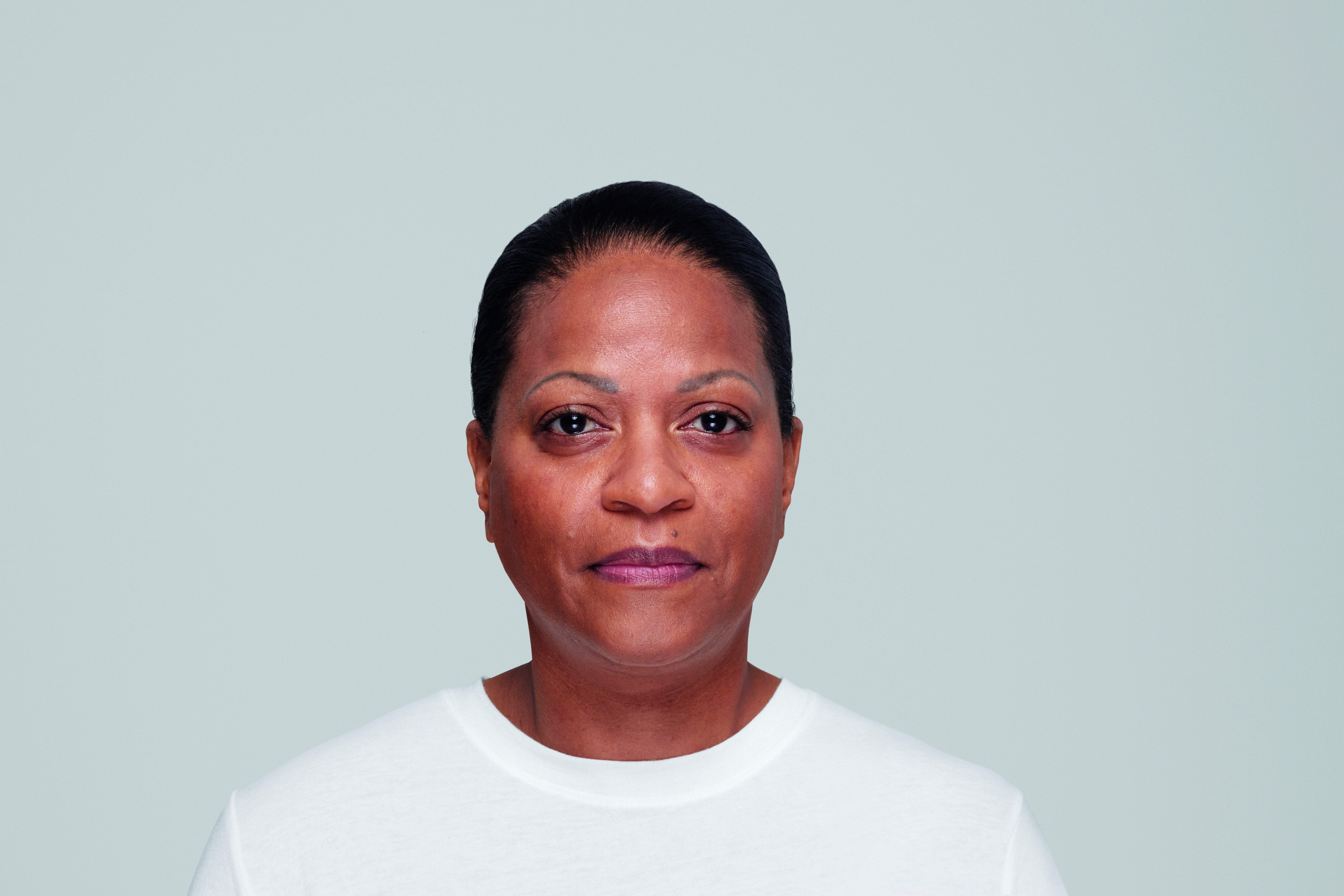 restylane patient