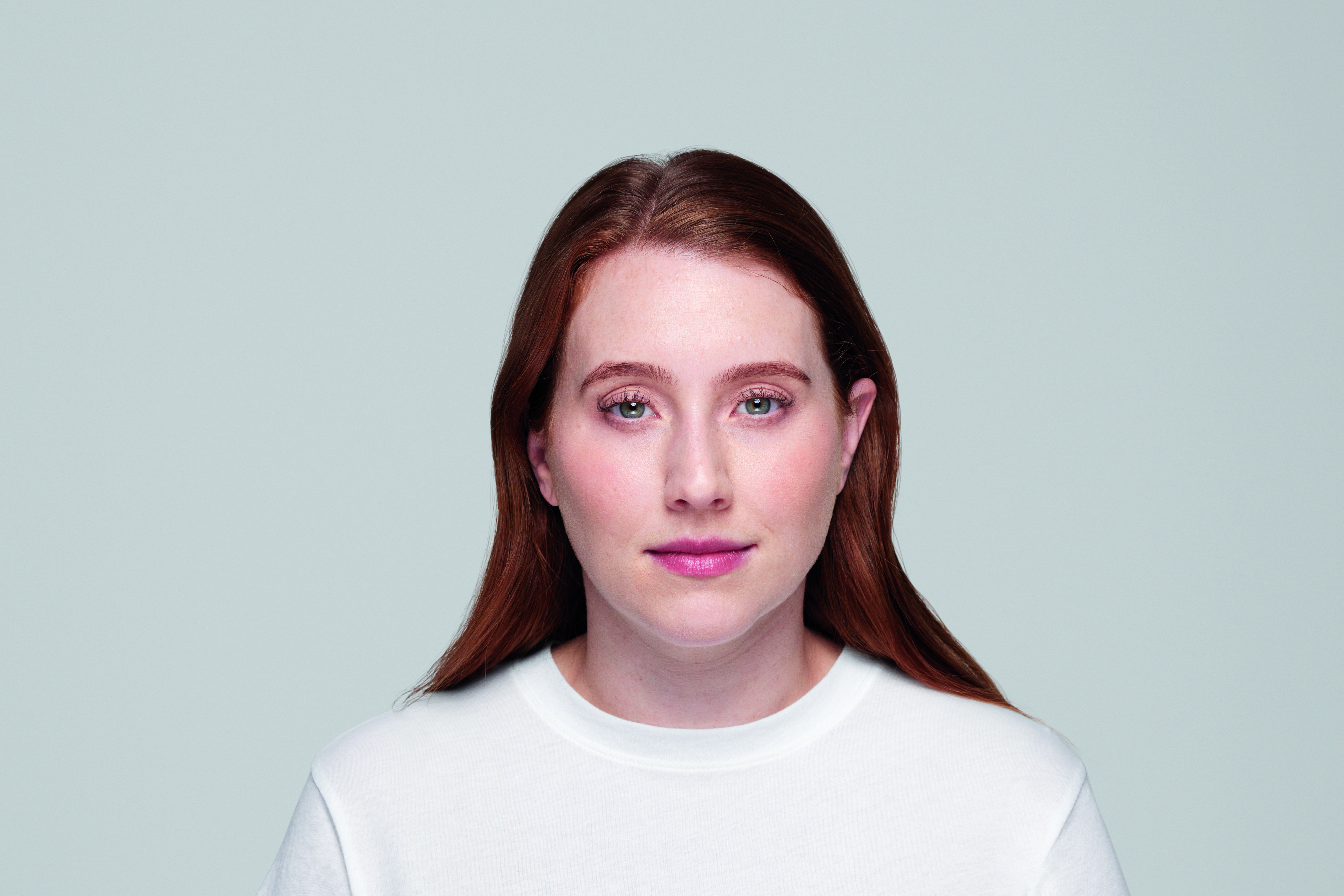 restylane patient