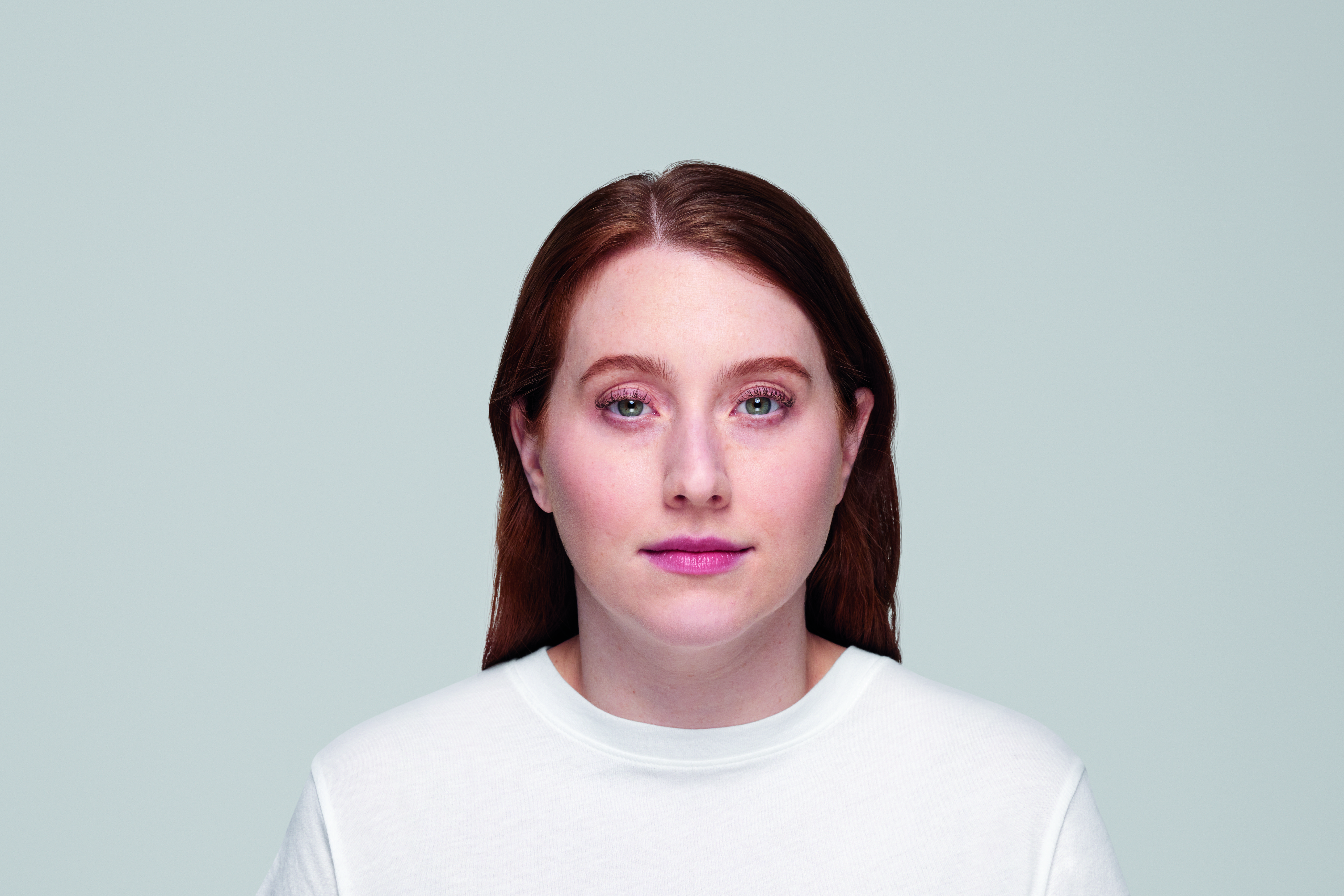 restylane patient