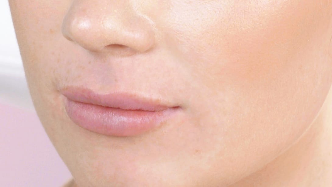 restylane patient