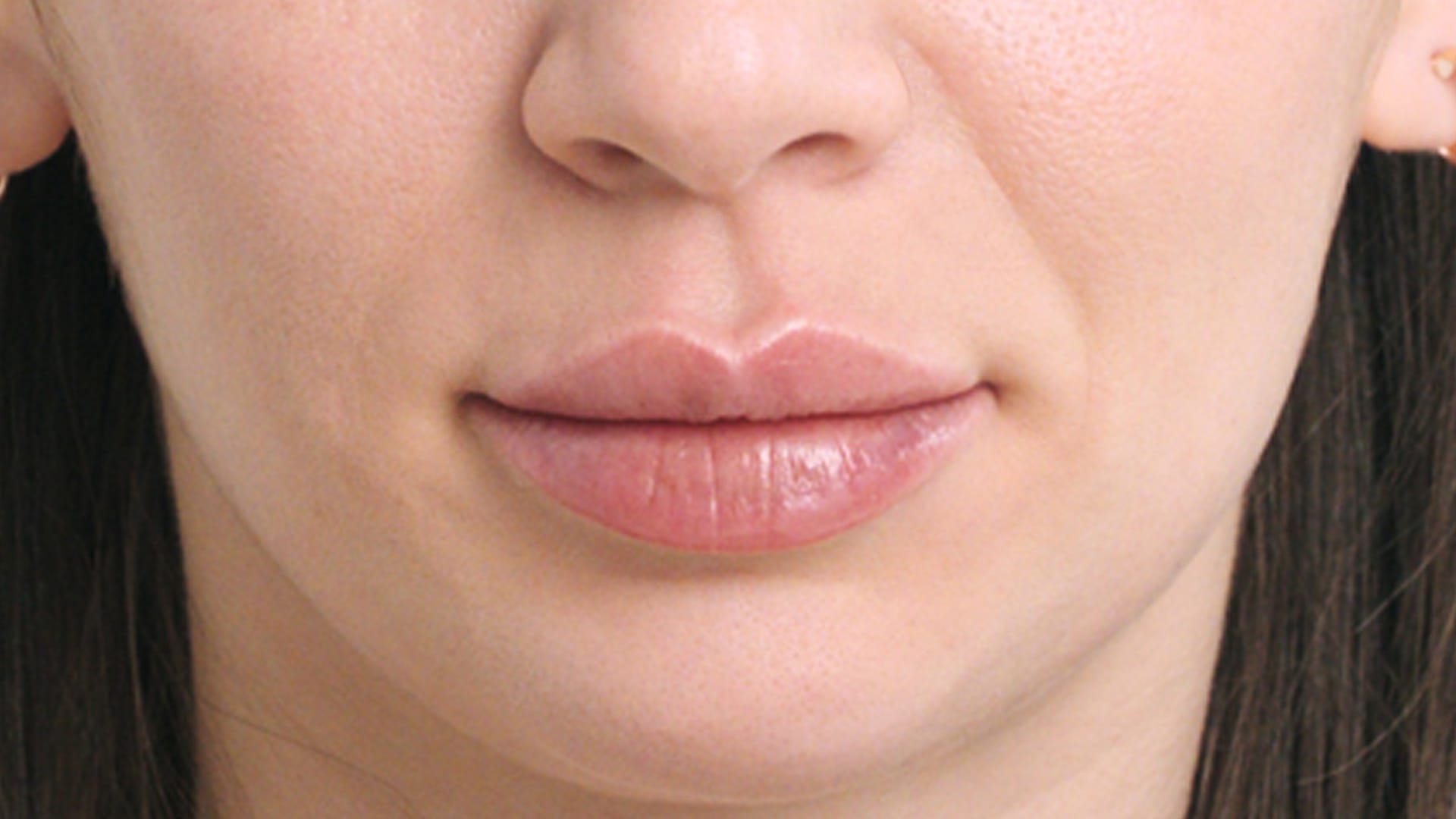 restylane patient