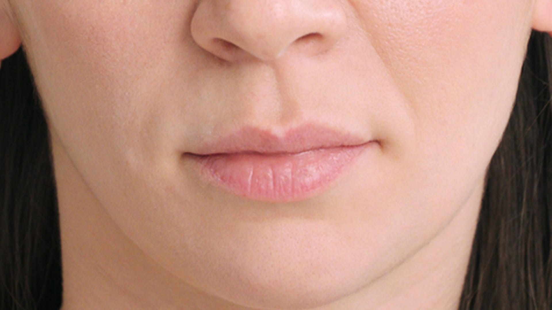 restylane patient