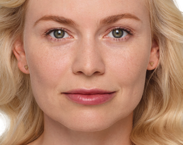 juvederm patient