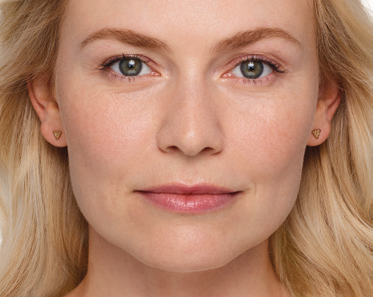 juvederm patient