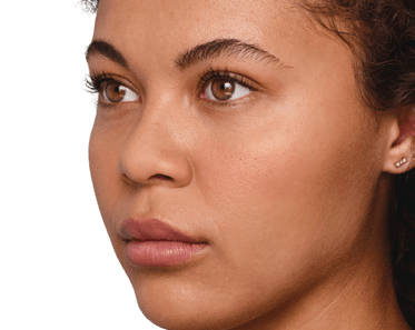 juvederm patient