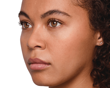 juvederm patient