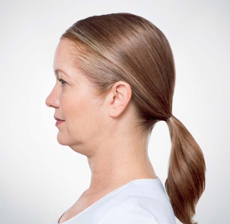 Kybella patient