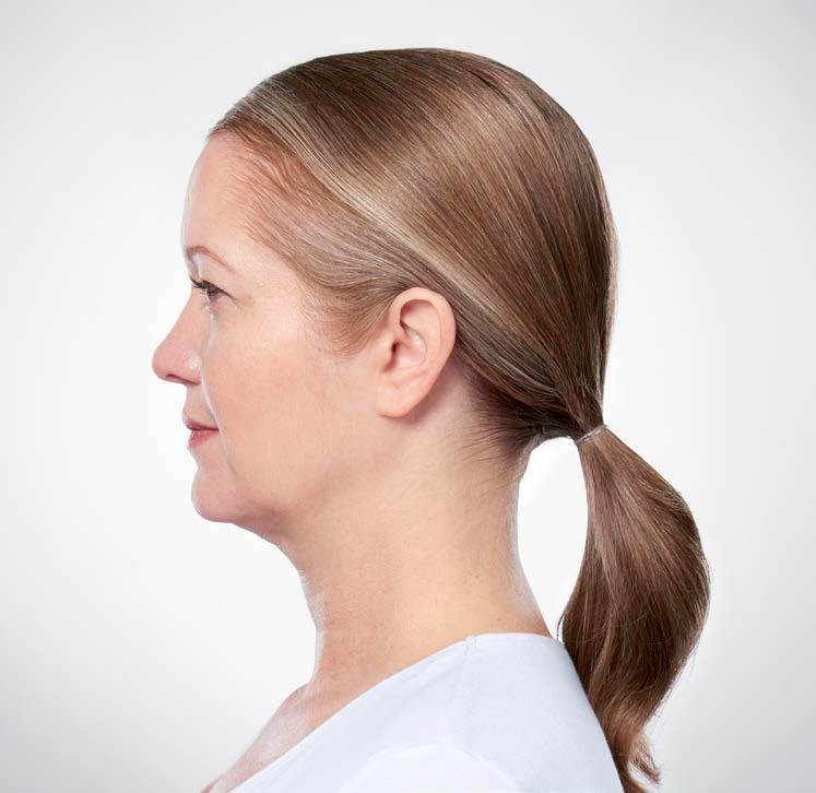 Kybella patient