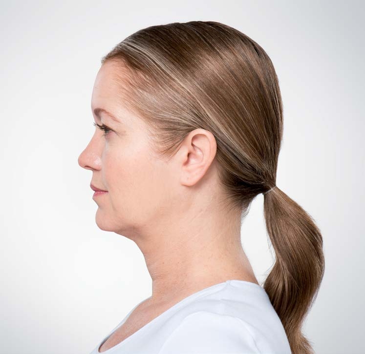 Kybella patient