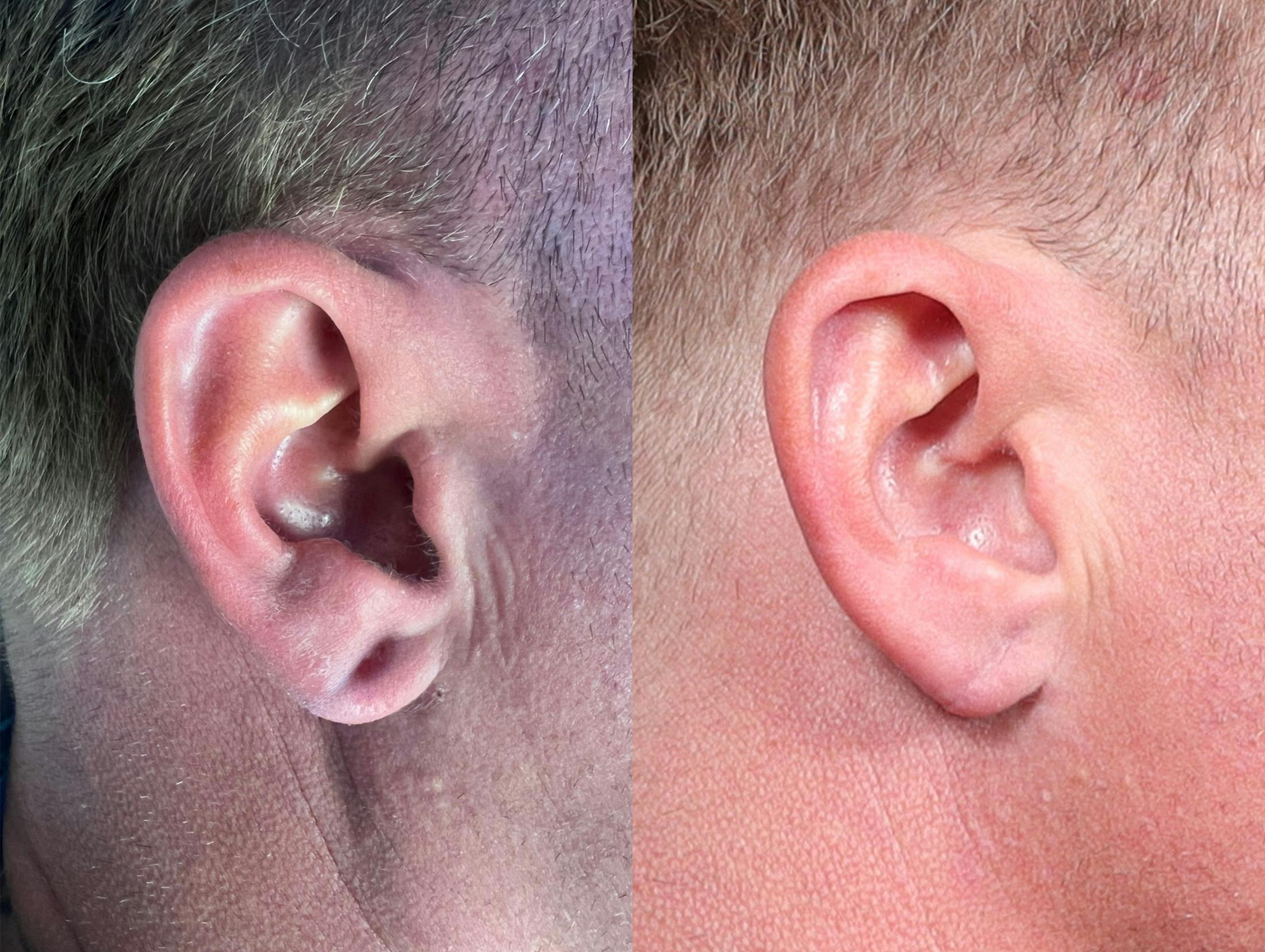 Earlobe Repair Before & After Gallery - Patient 259568 - Image 1