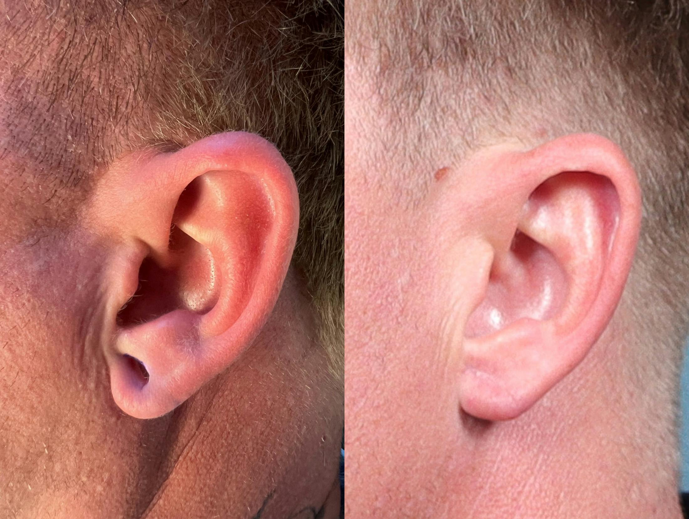 Earlobe Repair Before & After Gallery - Patient 259568 - Image 2