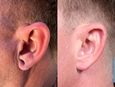 Earlobe Repair Before & After Gallery - Patient 259568 - Image 2