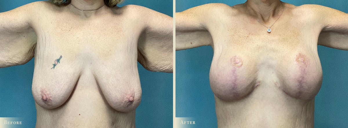 Arm Lift Before & After Gallery - Patient 428730 - Image 6