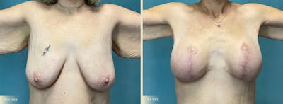 Breast Augmentation and Lift  Before & After Gallery - Patient 727702 - Image 1