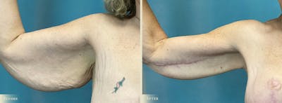 Arm Lift Before & After Gallery - Patient 428730 - Image 4