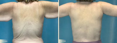 Arm Lift Before & After Gallery - Patient 428730 - Image 3