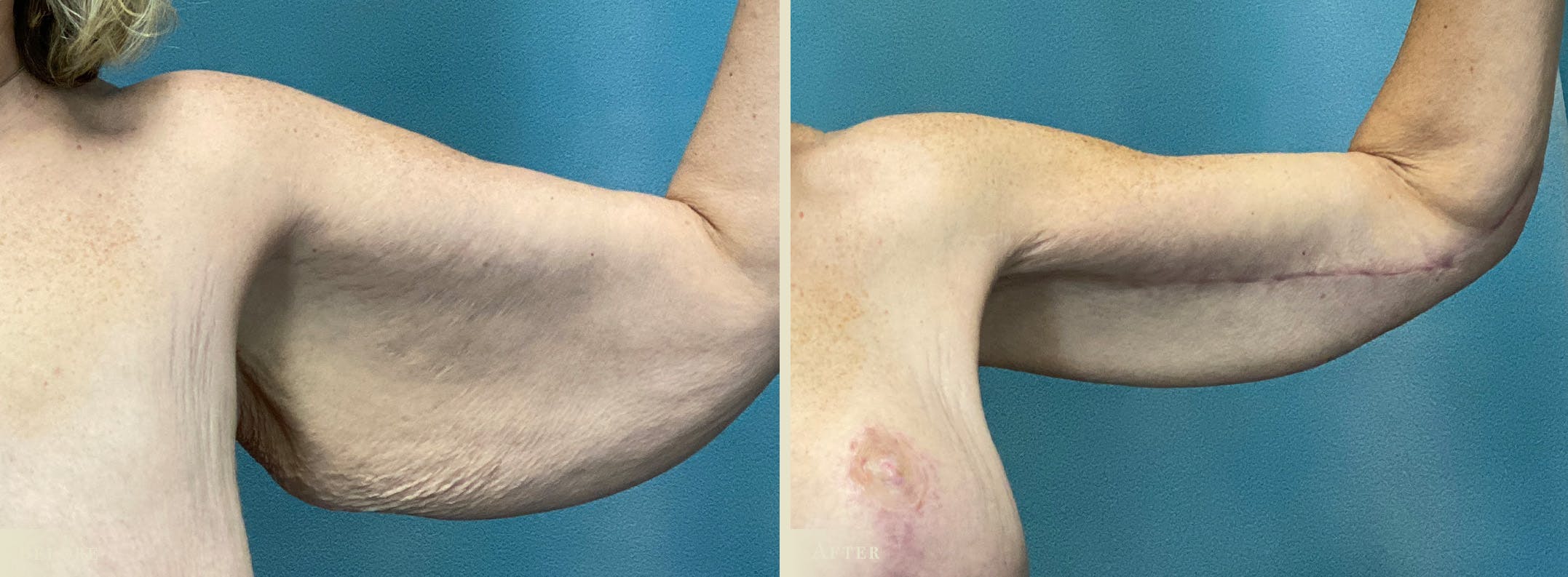 Arm Lift Before & After Gallery - Patient 428730 - Image 1