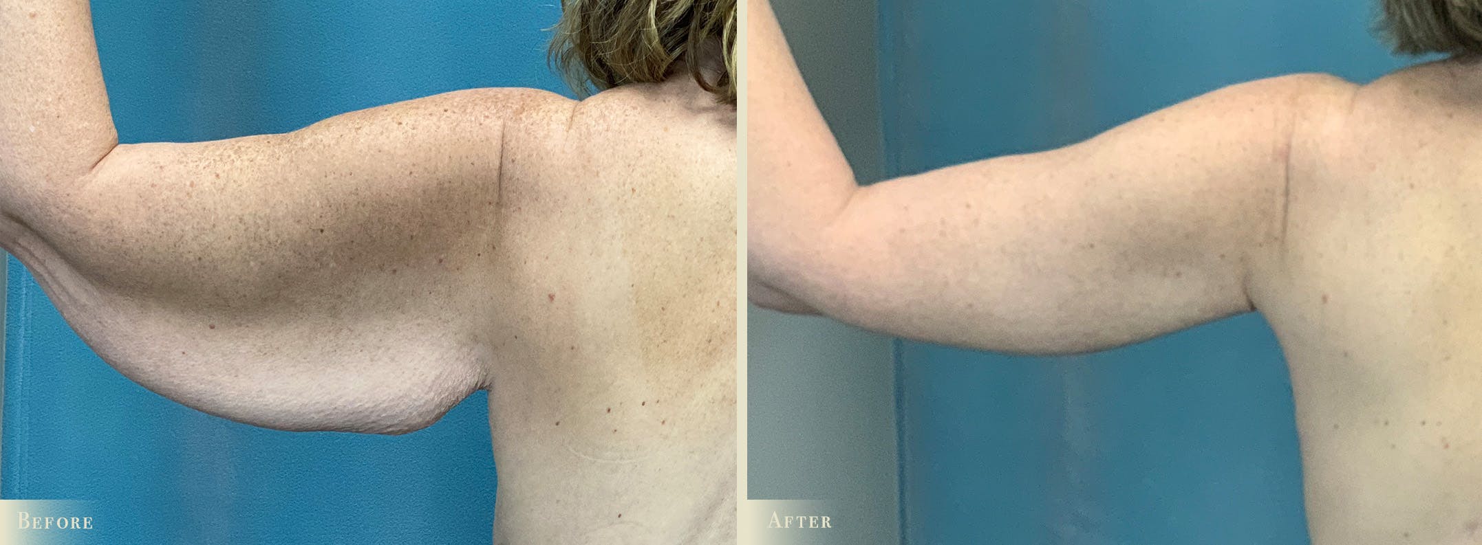 Arm Lift Before & After Gallery - Patient 428730 - Image 5