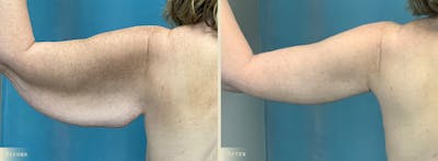 Arm Lift Before & After Gallery - Patient 428730 - Image 5